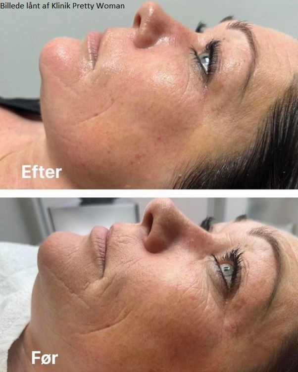 Før og efter trådløft 